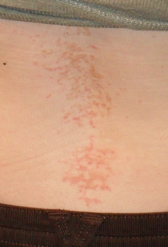lower back rash